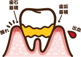 軽度歯周病