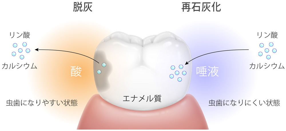 むし歯のリスクチェック